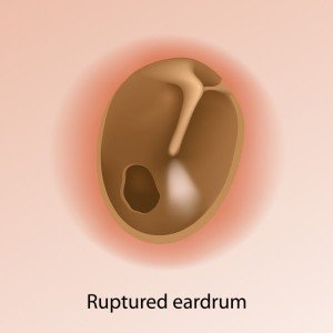 Ruptured Eardrum